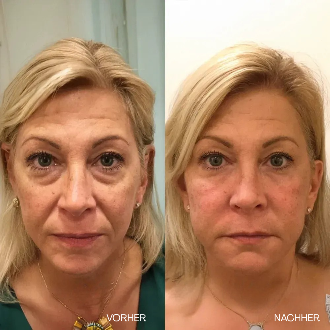V-Lift Augencreme – Sofort straffer aussehen