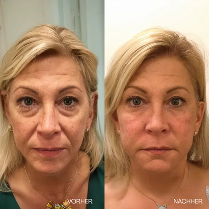 V-Lift Augencreme – Sofort straffer aussehen
